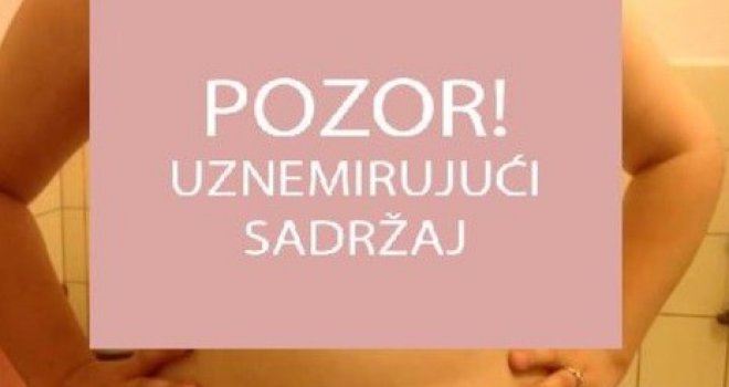 Život joj je postao pakao: Operisao pacijentici grudi, a njoj potpuno odumrle bradavice! 