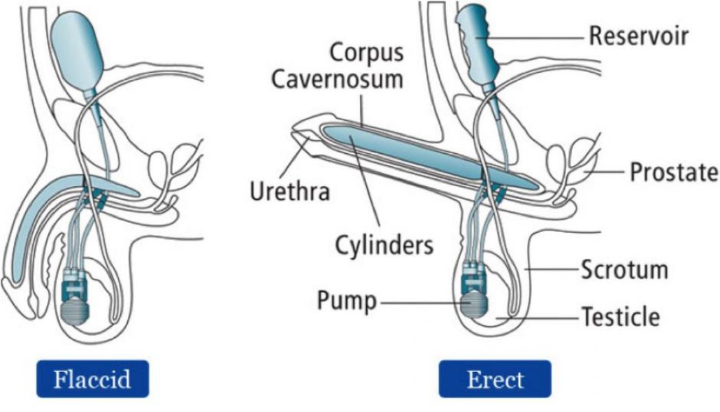 erekcija-prijapizam