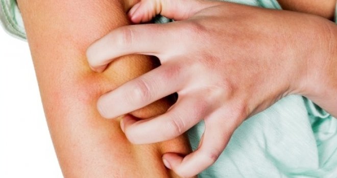 Kako prepoznati da li imate atopijski dermatitis? Ne liječite ga sami, ne uzimajte 'korisne' terapije - bit će još gore!